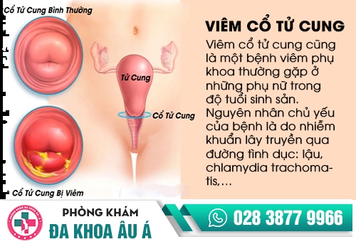 Ra máu khi quan hệ do viêm cổ tử cung